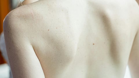 skin cancer
