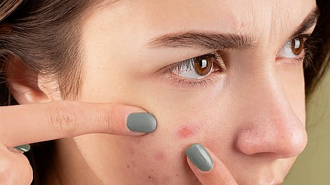 Pimples on face
