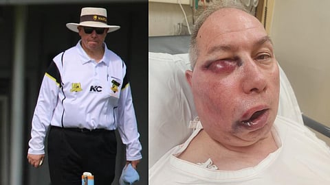 Umpire Suffers Serious Face Injury