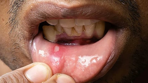 Mouth ulcer