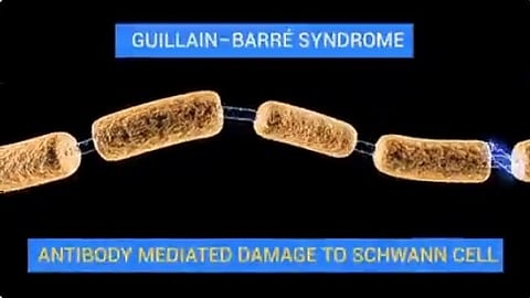  Guillain-Barre Syndrome
