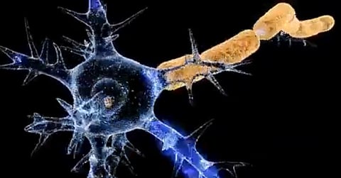 Guillain-Barre syndrome