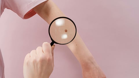holding a lens to see the moles on hand