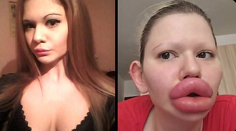 Woman gets world's biggest lips