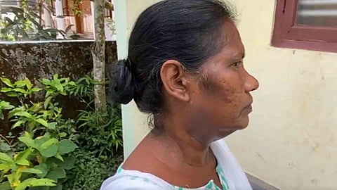 Booth Level Officer was attacked by a pet dog in kottayam Kerala