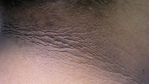Acanthosis Nigricans