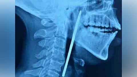 patient swallows scissors