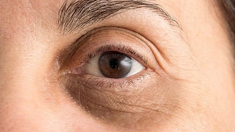 Dark Circles under eyes