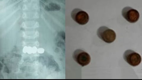 Successful Removal of Batteries from Child's Stomach