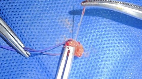 Extracted from an abscess on an elderly woman's face