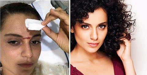 ഷൂട്ടിങ്ങിനിടെ വാളുകൊണ്ട് കങ്കണയ്ക്ക് ഗുരുതര പരിക്ക്; ഐസിസിയുവില്‍ പ്രവേശിപ്പിച്ചു