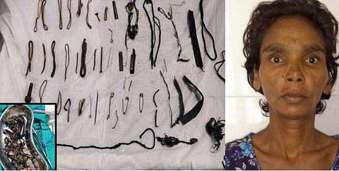 താലിമാല,വള, ഇരുമ്പാണി, സേഫ്റ്റി പിന്‍..യുവതിയുടെ വയറ്റില്‍ നിന്ന് ഡോക്ടര്‍മാര്‍ നീക്കം ചെയ്തത് ഒന്നരക്കിലോ ഇരുമ്പ് 