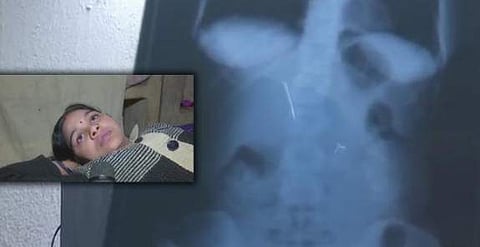 ശസ്ത്രക്രിയയ്ക്കിടെ യുവതിയുടെ വയറിനുള്ളില്‍ കുടുങ്ങിയത് മൂന്ന് സിറിഞ്ച്; ഡോക്ടര്‍ക്കെതിരെ കേസ്‌ 