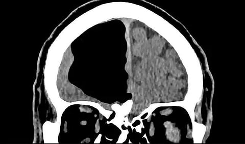 തലയില്‍ തലച്ചോറില്ല പകരം വായു നിറഞ്ഞ ഒരു അറ; 84 കാരന്റെ സ്‌കാന്‍ റിപ്പോര്‍ട്ട്‌ കണ്ട് ഞെട്ടി വൈദ്യശാസ്ത്ര മേഖല
