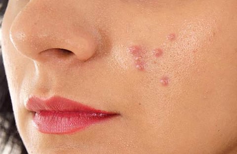 മുഖക്കുരു മാറ്റാന്‍ പത്തു മാര്‍ഗ്ഗങ്ങള്‍