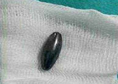 ഒന്‍പതു വയസുകാരി വിഴുങ്ങിയ കാന്തം പുറത്തെടുത്തത് മറ്റൊരു കാന്തം ഉപയോഗിച്ച്; ഡോക്റ്റര്‍മാരുടെ ബുദ്ധി അപാരം തന്നെ!