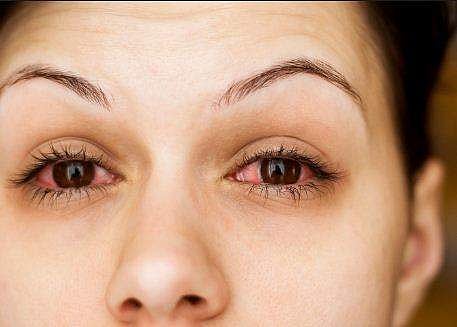 രോ​ഗിയുടെ കണ്ണിൽ നോക്കിയാൽ ചെങ്കണ്ണ് പകരുമോ? അറിയേണ്ടതെല്ലാം