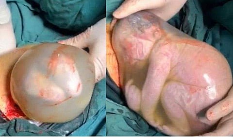 സിസേറിയനില്‍ പുറത്തുവന്നത് 'ബബിള്‍ ബോയ്' ; ഡോക്ടര്‍മാരെ ഞെട്ടിച്ച ജനനം, അസാധാരണം