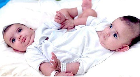 ലിബിയന്‍ സയാമീസ് ഇരട്ടകളുടെ സങ്കീര്‍ണ ശസ്ത്രക്രിയ നാളെ, വേര്‍പെടുത്തേണ്ടത് അടിവയറും ഇടുപ്പും