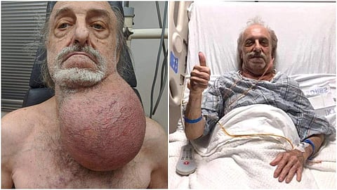 ഏഴ് മണിക്കുര്‍ നീണ്ട ശസ്ത്രക്രിയ; 81കാരന്റെ തൊണ്ടയില്‍ നിന്ന് ഫുട്‌ബോള്‍ വലുപ്പമുള്ള ട്യൂമര്‍ നീക്കി; (വീഡിയോ)