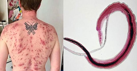 തടാകത്തില്‍ കുളിച്ചു; യുവാവിന്റെ ജനനേന്ദ്രിയത്തില്‍ വിര മുട്ടിയിട്ട് പെരുകി