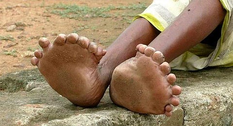 19 കാല്‍വിരലുകള്‍, 12 കൈവിരലുകള്‍; ദുര്‍മന്ത്രവാദിനിയെന്ന് നാട്ടുകാര്‍; ദുരിതം പേറിയ 63 വര്‍ഷങ്ങള്‍