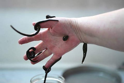 രണ്ട് മാസമായി തുടര്‍ച്ചയായി ചുമ; 60കാരന്റെ  തൊണ്ടയില്‍ നിന്ന് കണ്ടെത്തിയത് ജീവനുള്ള അട്ടകളെ