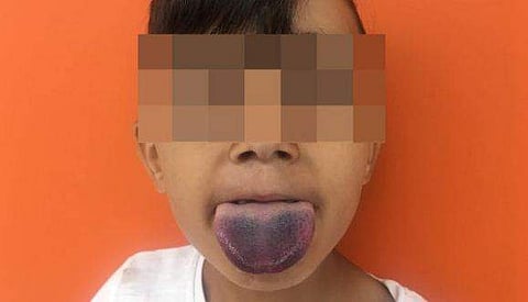 ജ്യൂസ് കുടിക്കുന്നതിനിടെ ഏഴു വയസുകാരന്റെ നാവ് കുപ്പിയില്‍ കുടുങ്ങി; വൈന്‍ ബോട്ടില്‍ തുറന്ന ഓര്‍മ്മ പരീക്ഷിച്ച് വിജയിപ്പിച്ച് ഡോക്ടര്‍