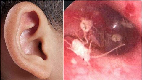 യുവാവിന്റെ ചെവിയില്‍ പാറ്റയും ജീവനുള്ള പത്തോളം കുഞ്ഞുങ്ങളും; ഡോക്ടര്‍മാര്‍ക്ക് വരെ ഞെട്ടല്‍