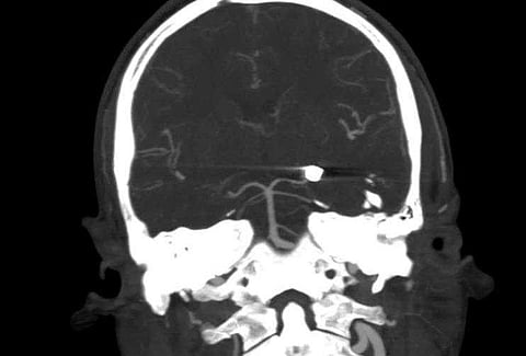 യുവാവിന്റെ തലയിൽ വെടിയുണ്ട തുളഞ്ഞു കയറി; പുറത്തെടുത്തത് അതി സങ്കീർണ ശസ്ത്രക്രിയയിലൂടെ 
