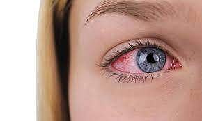 മൈഗ്രേനും കണ്ണ് വരള്‍ച്ചയും തമ്മില്‍ ചെറിയ ബന്ധമൊന്നുമല്ല..!