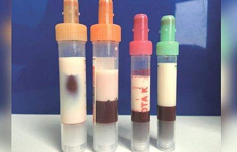 രക്തം പാലുപോലെ വെളുത്തു, കട്ടികൂടി; അപൂര്‍വ രോഗം ബാധിച്ച് യുവാവ്; ഞെട്ടി ലോകം