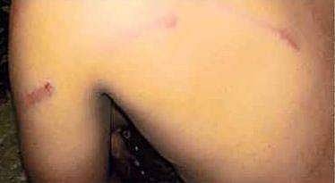 വെള്ളം കുടിക്കുന്നതിനിടെ ചുണ്ട് ജഗ്ഗില്‍ മുട്ടി ; ഭിന്നശേഷിക്കാരനായ യുവാവിനെ പട്ടിക കൊണ്ട് അടിച്ചു പരിക്കേല്‍പ്പിച്ചു