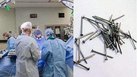 ശസ്ത്രക്രീയയിലൂടെ രോഗിയുടെ വയറ്റില്‍ നിന്നും പുറത്തെടുത്തത് 116 ഇരുമ്പാണികള്‍; കൂടെ പ്ലാസ്റ്റിക് വയറും, ഇരുമ്പ് തിരയും