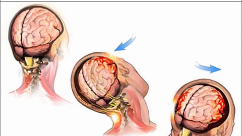 പനി, തൊണ്ടവേദന ഉള്‍പ്പെടെയുളള രോഗലക്ഷണങ്ങള്‍ കണ്ടാല്‍ ഉടന്‍ ചികിത്സ തേടണം; മസ്തിഷ്‌ക ജ്വരത്തില്‍ മുന്നറിയിപ്പുമായി ആരോഗ്യവകുപ്പ് 