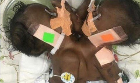 ഒരു ഹൃദയം മാത്രമുള്ള സയാമീസ് ഇരട്ടകള്‍, അപൂര്‍വ ശസ്ത്രക്രീയയിലൂടെ ഒരു കുഞ്ഞിന് പുതുജീവന്‍