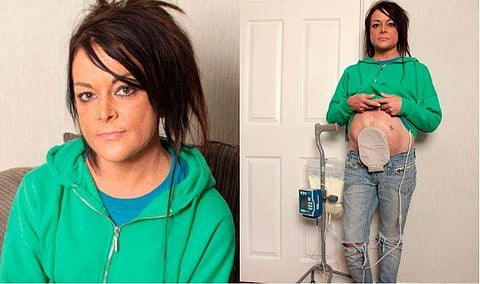 സിസേറിയന്‍ മുറിവിലൂടെ ആന്തരികാവയവങ്ങള്‍ പുറത്തു വരുന്ന അപൂര്‍വ്വ രോഗം; പൊരുതി 43കാരിയായ മിഷേല്‍  