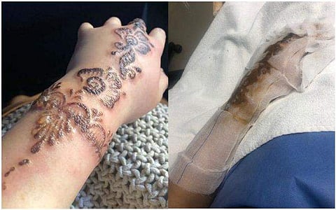 'ഭാ​ഗ്യം കൊണ്ടാണ് രക്ഷപ്പെട്ടത്': മെഹന്തി ഇട്ടതിന് പിന്നാലെ കൈ പൊള്ളി വീർത്തു, അണുബാധ; അനുഭവം പങ്കുവച്ച് യുവതി 