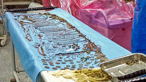 അമ്പരന്ന് ഡോക്ടർമാർ; യുവതിയുടെ വയറ്റിൽ നിന്ന് കിട്ടിയത് ഒന്നരക്കിലോ ആഭരണങ്ങളും നാണയങ്ങളും