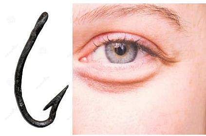 ഇല പറിക്കുന്നതിനിടെ വീട്ടമ്മയുടെ കണ്ണില്‍ ചൂണ്ടക്കൊളുത്ത് തുളഞ്ഞുകയറി ; ഒരു മണിക്കൂര്‍ നീണ്ട ശസ്ത്രക്രിയയിലൂടെ പുറത്തെടുത്തു