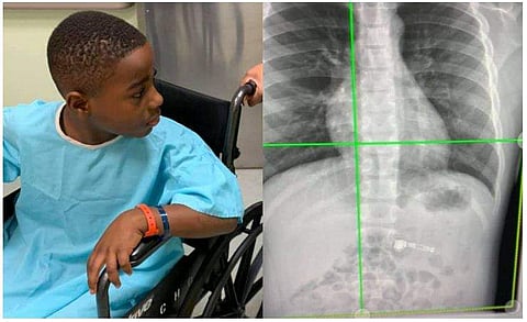 ക്രിസ്മസിന് സമ്മാനം നൽകിയ എയർപോഡ് ഏഴുവയസുകാരൻ വിഴുങ്ങി; എക്സ് റേ പോസ്റ്റ് ചെയ്ത് അമ്മയുടെ കുറിപ്പ് 