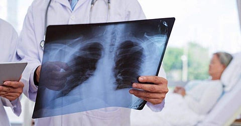 രണ്ടു വര്‍ഷം മുന്‍പ് ശ്വാസകോശത്തില്‍ പല്ല് കുടുങ്ങി, മാറാതെ ന്യൂമോണിയ; നീക്കം ചെയ്തു