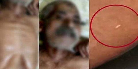 കോവിഡ് രോഗിയെ പുഴുവരിച്ച സംഭവം; നോഡല്‍ ഓഫീസര്‍ക്കും രണ്ട് ഹെഡ് നേഴ്‌സുമാര്‍ക്കും സസ്‌പെന്‍ഷന്‍