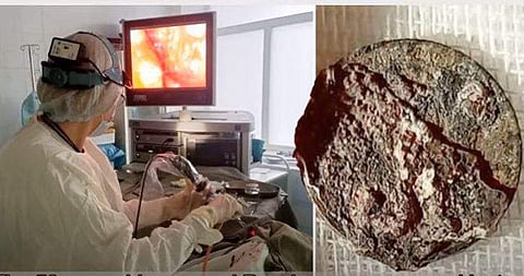 50 വര്‍ഷമായി മൂക്കില്‍ കുടുങ്ങി കിടന്ന് നാണയം, 'ശ്വാസം കിട്ടാതെയായി'; പുറത്തെടുത്തു (വീഡിയോ)