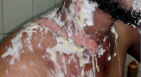 വാക്കേറ്റം കയ്യാങ്കളിയായി; കാര്‍ യാത്രക്കാരന് നേരെ തിളച്ച പാല്‍ ഒഴിച്ച് ബേക്കറി ജീവനക്കാരന്‍