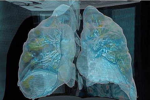 നിർബന്ധമായും സാമൂഹിക അകലം പാലിക്കണം; കോവിഡിന്റെ പരിണിത ഫലങ്ങള്‍ ഇങ്ങനെ; രോ​ഗിയുടെ ശ്വാസകോശ ചിത്രങ്ങൾ പുറത്തുവിട്ട് വി​ദ​ഗ്ധർ (വീഡിയോ)