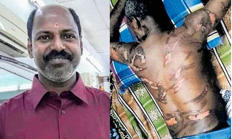 ശമ്പളം ചോദിച്ചതിന് ഇരുമ്പുദണ്ഡ് പഴുപ്പിച്ചു വെച്ചു; ശരീരം മുഴുവന്‍ പൊള്ളലേറ്റ പാട്; മലേഷ്യയില്‍ മലയാളിക്ക് ദുരിതജീവിതം