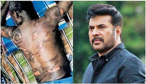 തൊഴിലുടമയുടെ ക്രൂരപീഡനത്തിന് ‌‌‌ഇരയായ ഹരിദാസന് സഹായവുമായി മമ്മൂട്ടി; ചികിത്സ പതഞ്ജലി ഏറ്റെടുക്കും 