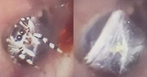 സ്ത്രീയുടെ ചെവിക്കുള്ളിൽ എട്ടുകാലി വല കെട്ടി താമസിച്ചു! പുറത്തെടുത്ത് ഡോക്ടർമാർ; അമ്പരപ്പിക്കുന്ന വീഡിയോ