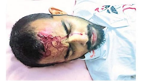 കണ്ണൂരിൽ സിപിഎം പ്രവർത്തകന് വെട്ടേറ്റു ; അക്രമത്തിന് പിന്നിൽ ആർഎസ്എസ് എന്ന് പരാതി